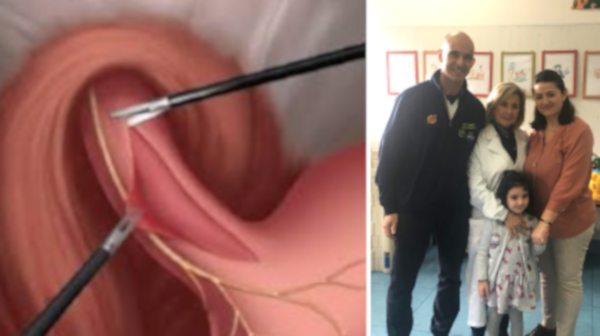 intervento esofago policlinico federico ii