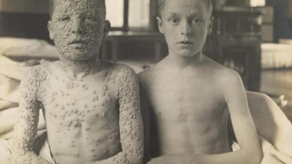 Gli Stabilimenti Vaccinici: così i Borbone vinsero la guerra contro il vaiolo