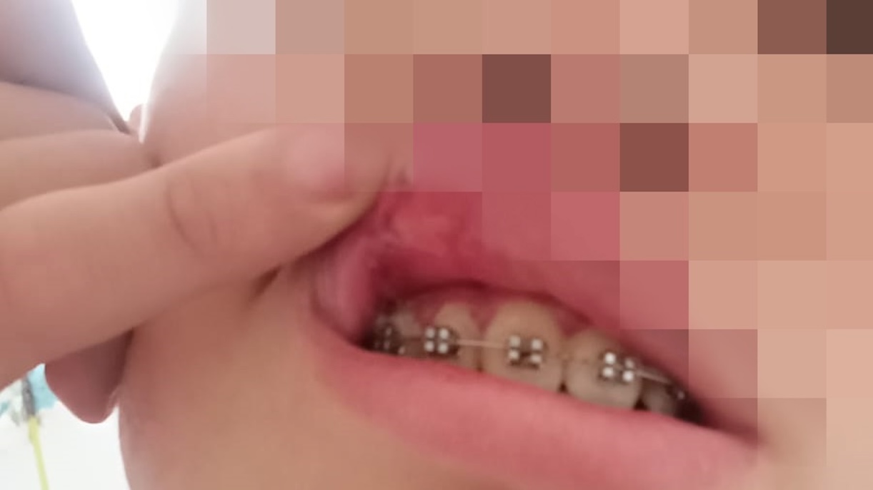 Napoli, gli rompono il labbro a suon di schiaffi: 15enne aggredito alla Galleria Umberto I